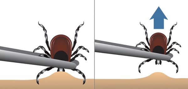 Proper-tick-removal.jpg